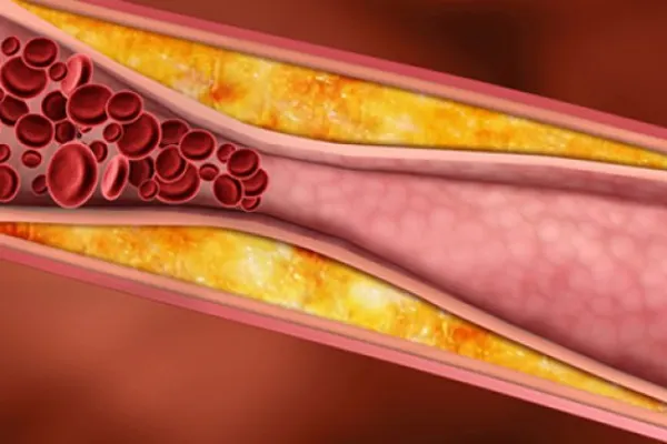 Alimentele care îți distrug organismul în doar 9 zile. Îngustează arterele și încetinesc metabolismul