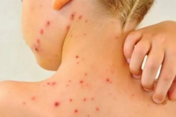Pericol de sănătate în Europa: boala considerată eradicată care revine acum