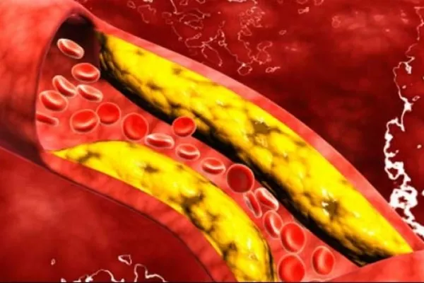 Alimentele care topesc depunerile de colesterol de pe vasele de sânge