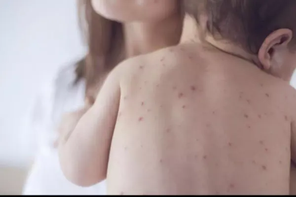 Rujeola lovește din nou România. Avertisment pentru cei care refuză vaccinarea: „Poate fi responsabil pentru sănătatea unui copil”
