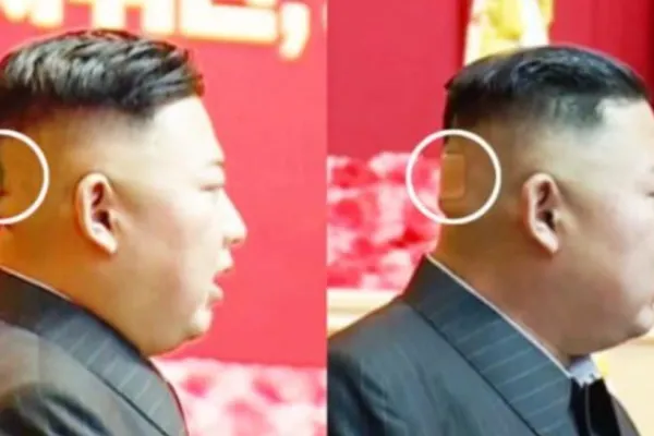 Un bandaj apărut pe ceafa lui Kim Jong Un adâncește misterul legat de starea de sănătate a dictatorului nord-coreean