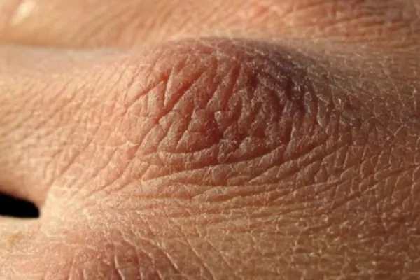 Ce înseamnă dacă pielea de pe mâini arată așa? E un simptom care îți pune în pericol sănătatea