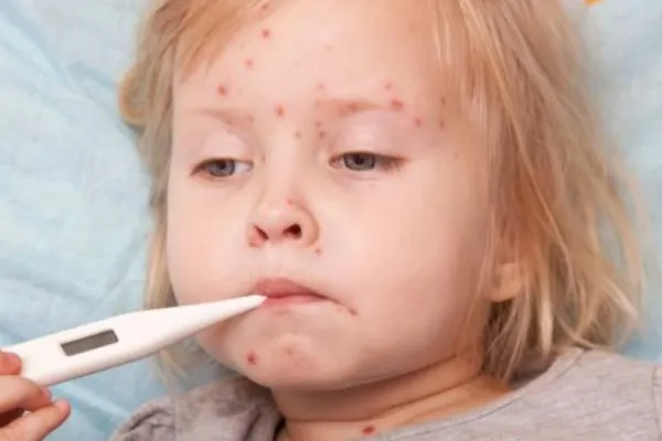 Mai multe focare de VARICELĂ, active la unele scoli şi grădinițe din Constanța! Reacția DSP: Deocamdată NU este vorba de epidemie