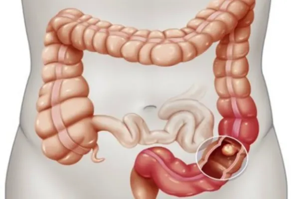 Alimentele care cresc riscul de cancer la colon. Scoate-le rapid din alimentație!