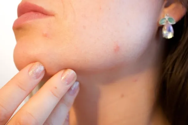 De ce apare acneea tardiva? Probleme de sănătate cu care te confrunți