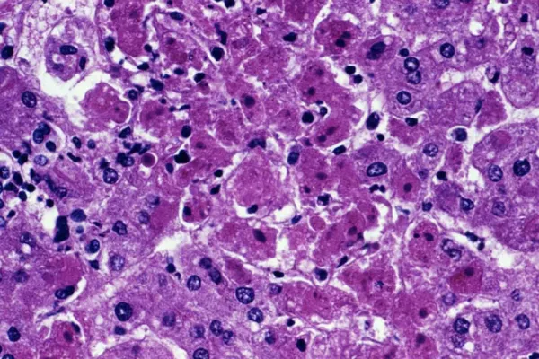 Alertă în Europa: Febra hemoragică Marburg, MORTALĂ, depistată la o persoană care a fost în focarul african - Nu există tratament