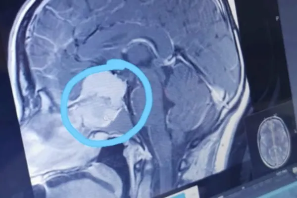 Persoanele cu această grupă de sânge au cel mai mare risc de accident vascular cerebral