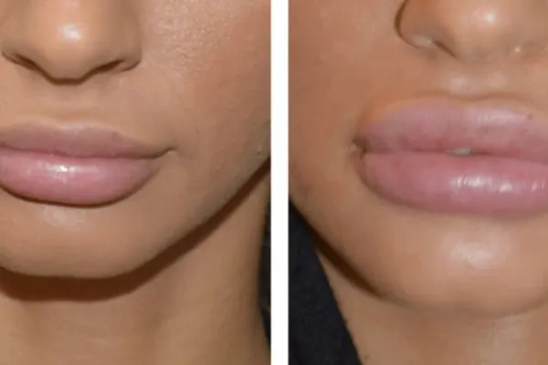 O influenceriță a murit după ce și-a injectat acid hialuronic - Trupul tinerei a fost găsit aruncat într-un râu