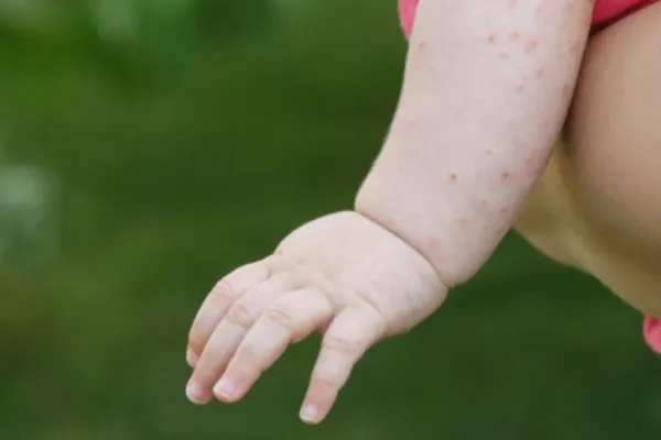 ALERTĂ în România - Epidemie de RUJEOLĂ la nivel național, declarată de Ministerul Sănătății - Cifre alarmante: 2.000 de cazuri în 29 de județe