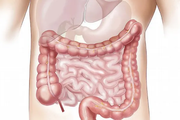 Alimente care previn cancerul de colon. Trebuie să le introduci în alimentația ta