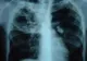 Obezitatea şi fumatul duc în egală măsură la deces, potrivit unui studiu 