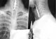 Un chinez a ajuns la spital cu o forfecuţă de unghii înfiptă în esofag