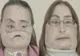 O femeie care a suferit un transplant facial s-a prezentat în faţa opiniei publice - IMAGINI ŞOCANTE