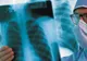 Guvernul a aprobat fondurile pentru tratamentele în străinătate de care au nevoie opt pacienţi