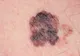 Un nou medicament testat pentru tratarea melanomului s-a dovedit eficient în reducerea tumorilor