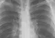 Primele semne ale cancerului pulmonar ar putea fi detectate cu ajutorul unui test respirator -studiu