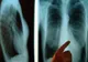 Pacienţii din Covasna deserviţi de doar doi radiologi