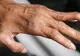 Un nou caz de lepră a fost confirmat la Cluj-Napoca. Sunt primele două cazuri înregistrate în România din 1981
