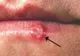 Ce boală gravă poate provoca un banal herpes