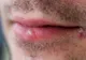 Tot ce trebuie să ştii despre herpes