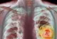 Imunoterapia, tratamentul revoluţionar care face ca tumorile canceroase să dispară