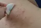 Cum scapi de coșurile de pe spate. Cele mai simple metode naturiste