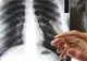 Alimentul minune care ne apără plămânii dacă îl consumăm în mod regulat