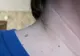 Ce sunt papiloamele, cât de periculoase sunt și cum pot fi îndepărtate