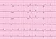 Super veste! Brotac Medical Center are grijă de inima ta! Îți oferă gratuit electrocardiograma!
