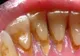 Cea mai eficientă metodă de îndepărtare a tartrului. Nu mai ai nevoie de dentist