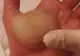 Avea o bășică imensă în palmă din cauza unei arsuri. A înțepat-o cu un ac! Ce a urmat l-a îngrozit