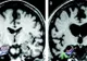Descoperire surprinzătoare. Ce au văzut medicii în creierul unui bolnav de Alzheimer