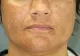 Exclusiv! Cum tratezi Melasma, plăcile pigmentare de pe față