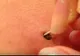 Avea un punct negru pe piele de 25 de ani. A luat o pensetă și a început să tragă. Era să leșine!