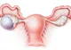 Cauza nebănuită a cancerului ovarian. Multe femei se îmbolnăvesc din cauza acestui produs