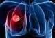 Mănâncă acest aliment ca să previi cancerul de plămâni