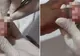 I-a crescut unghia până a intrat în piele. Medicul a tăiat excesul. A leșinat când a văzut ce scoate