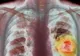 Ai aceste simptome? Ar putea fi cancer pulmonar
