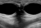 Acest amestec distruge chisturile mamare şi fibromul