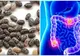 Probabil cel mai bun remediu natural pentru cancerul de colon. Din păcate, puțină lume îl știe