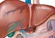 Ficatul nu doare! Cum descoperi că ai o afecţiune hepatică 