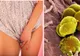 O boală sexuală a devenit imună la antibiotice și face ravagii. Cât de mare este pericolul