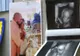 Caz extrem de rar. O femeie a devenit mamă de două ori la distanţă de 38 de zile