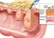Cancerul de colon nu dă niciun simptom în faza incipientă. Cum pot fi prevenite 98% din cazuri