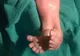 Imagini greu de privit! Bebeluşul-sirenă, născut în India, care a bulversat lumea medicală