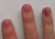 Ai observat că ai nişte linii maro pe unghii? Mergi de urgenţă la medic!