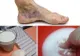 Tratament pentru vene vericoase și tromboză cu două ingrediente