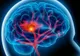 Testul care îţi arată dacă eşti predispus la accident vascular cerebral