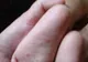 Atenţie, părinţi! Epidemie în sudul ţării, la preşcolari: care sunt simptomele bolii