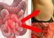 Simptomele cancerului de colon, boala care afectează una din 20 de persoane